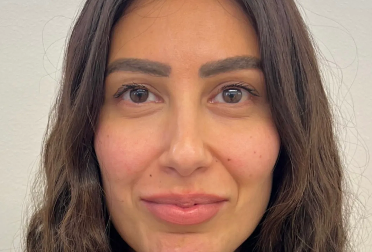 Nasolabialaveck resultat