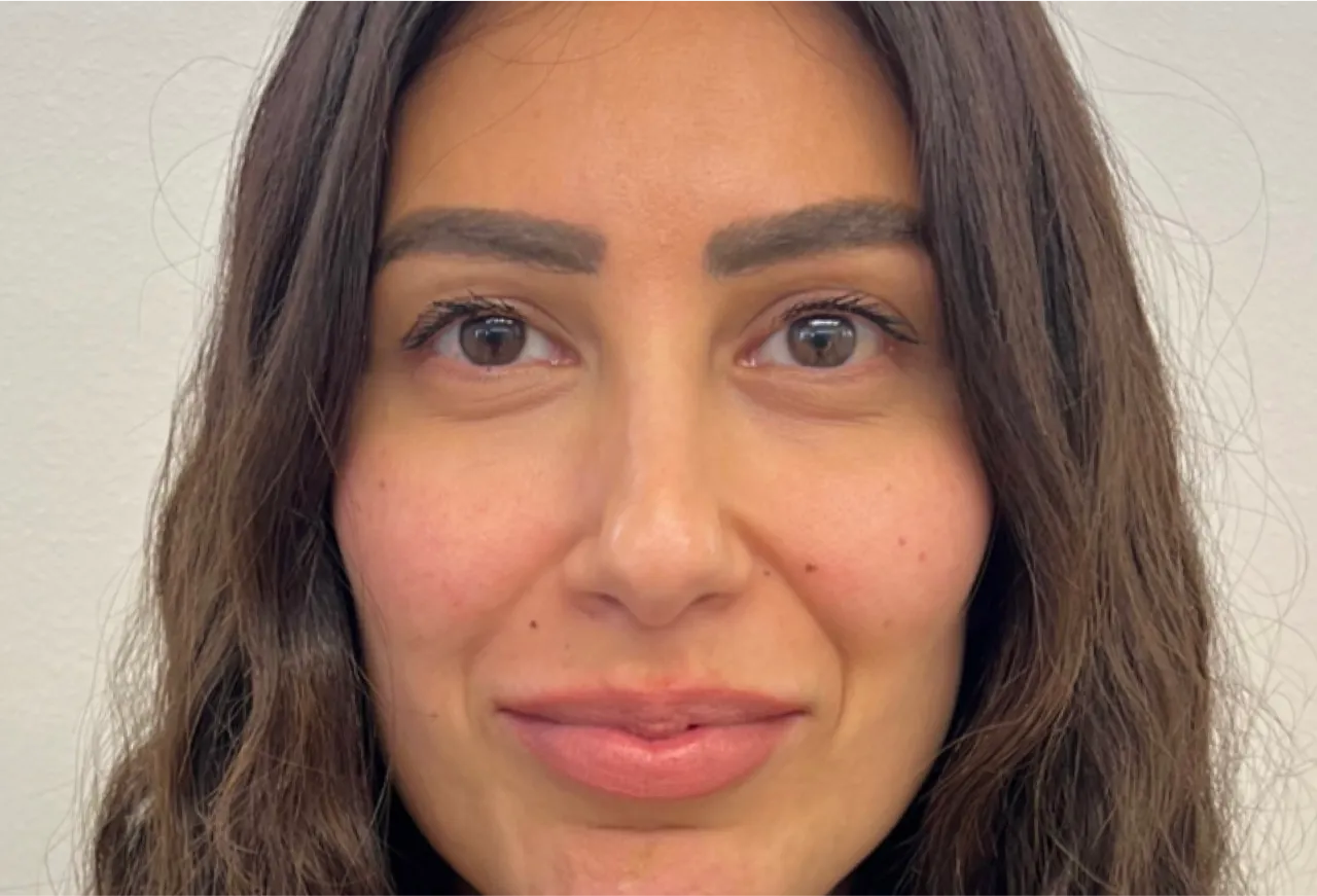 Nasolabialaveck resultat 3