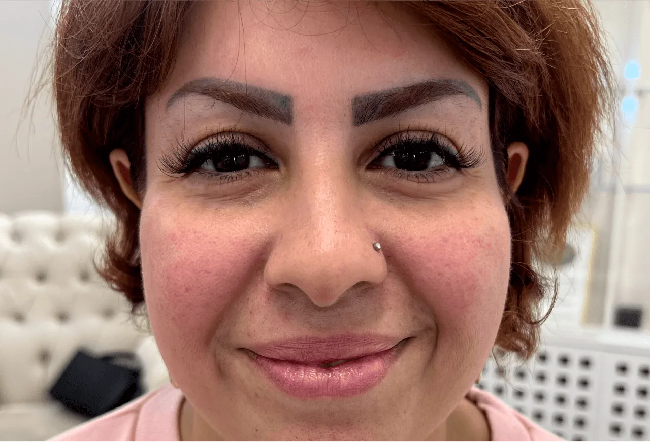 Nasolabialaveck resultat 5