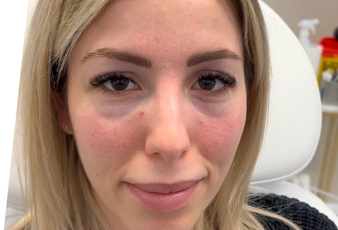 Tear Trough resultat