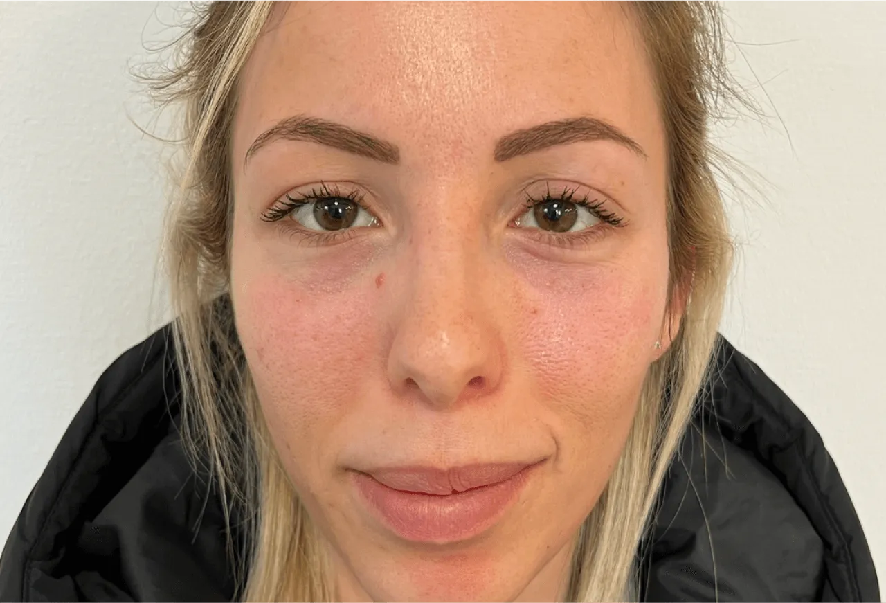 Tear Trough resultat