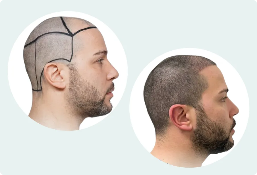 Donatorområdet med markerade uttagszoner och det täta, naturliga resultatet efter en hårtransplantation