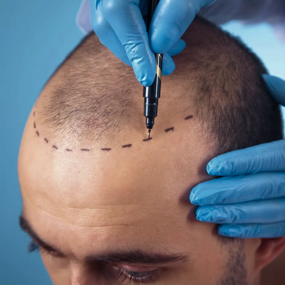 Läkare ritar upp en ny, naturlig hårlinje inför en hårtransplantation