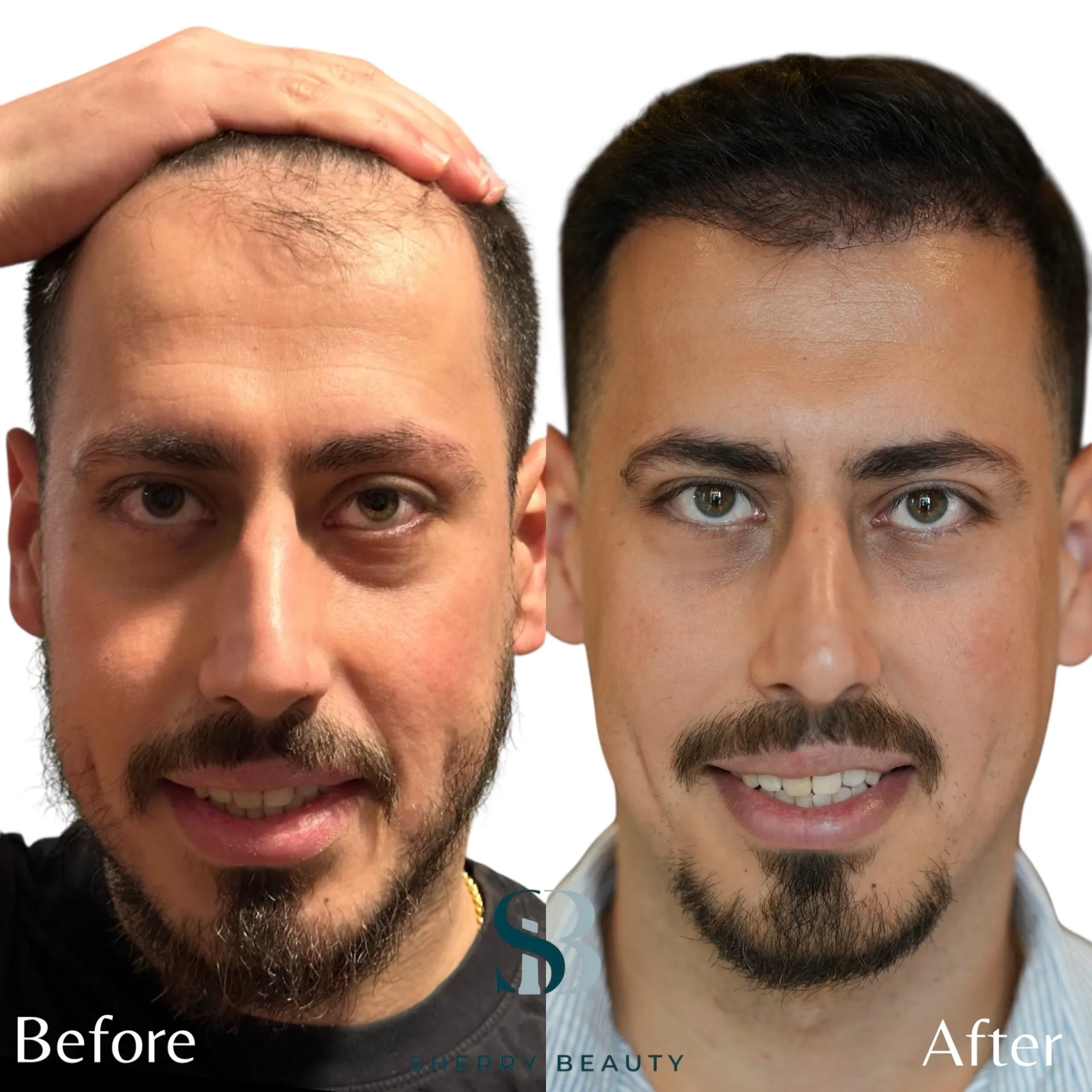 Före och efter hårtransplantation — patient i ålder 18–29, resultat efter 12 mån.