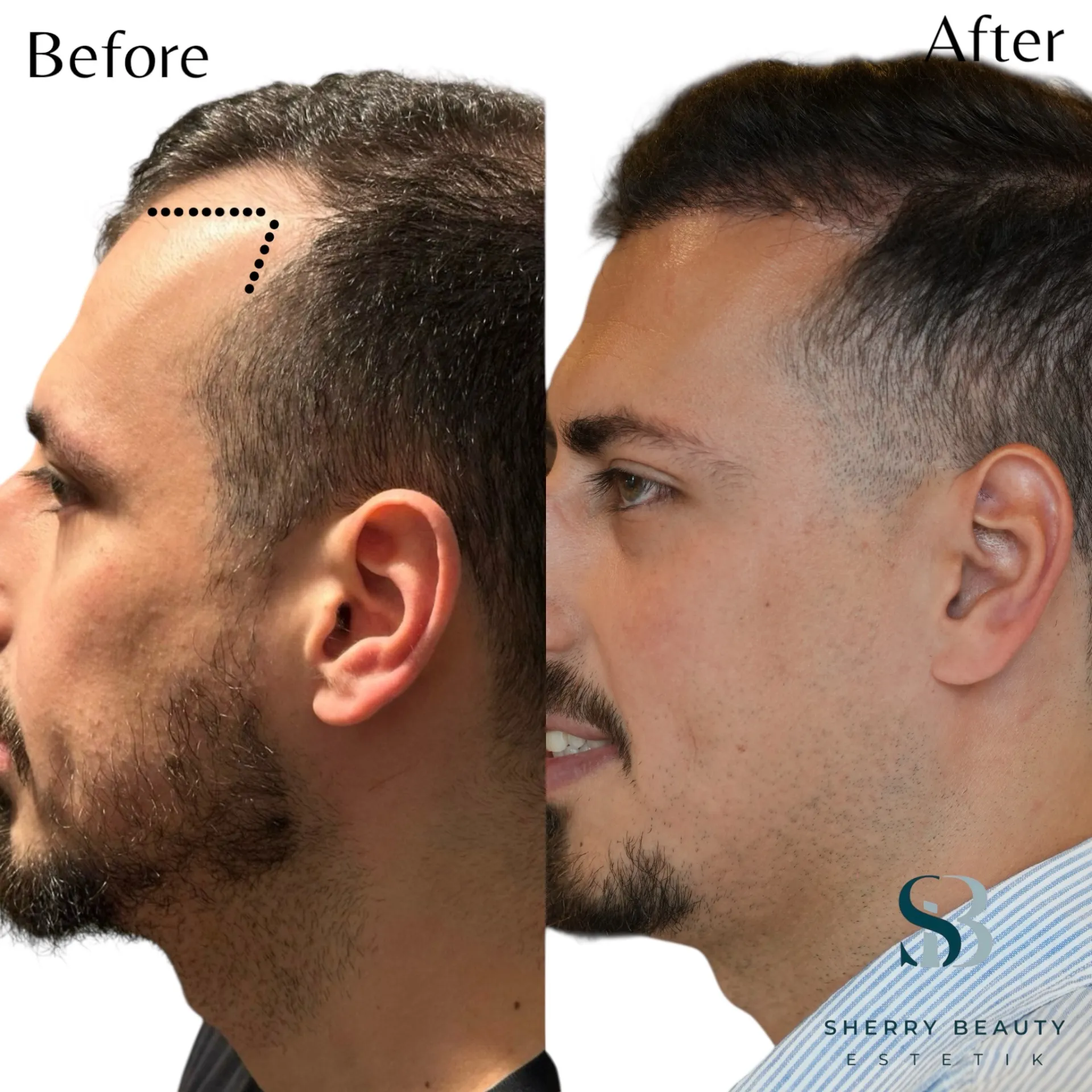 Före och efter hårtransplantation 1