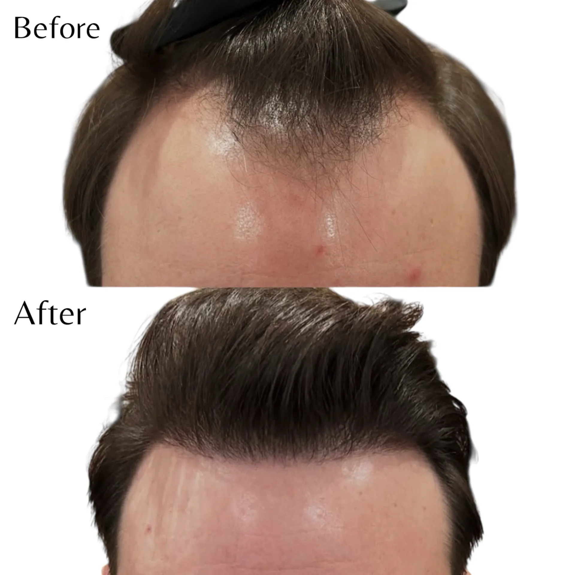 Före och efter hårtransplantation 3