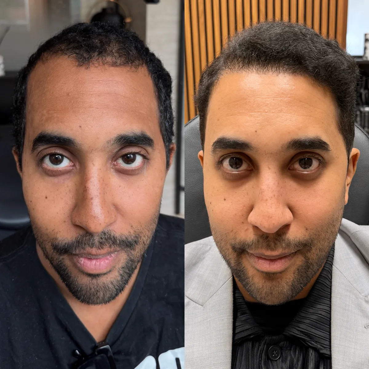Före och efter hårtransplantation 4