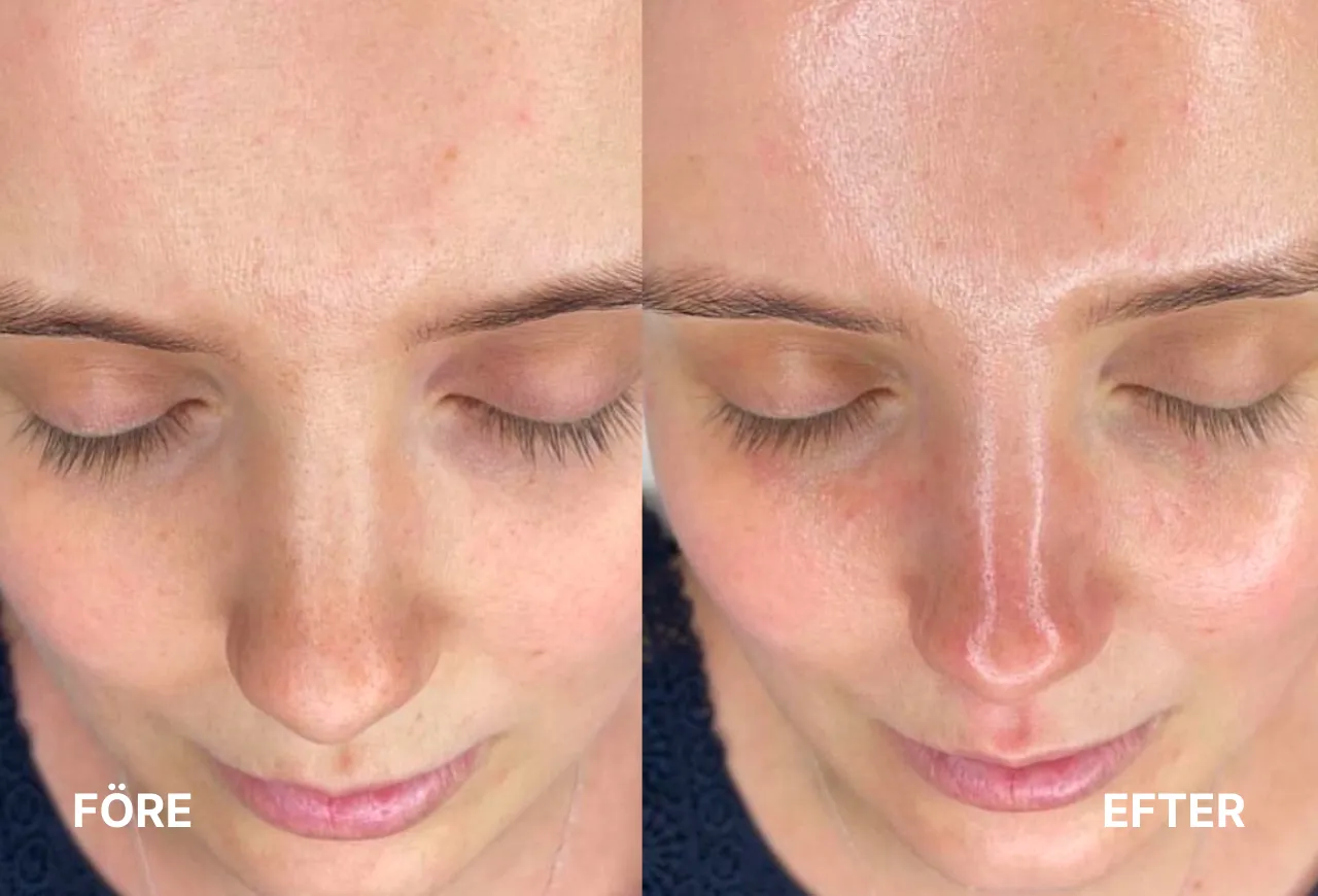 Dermapen resultat
