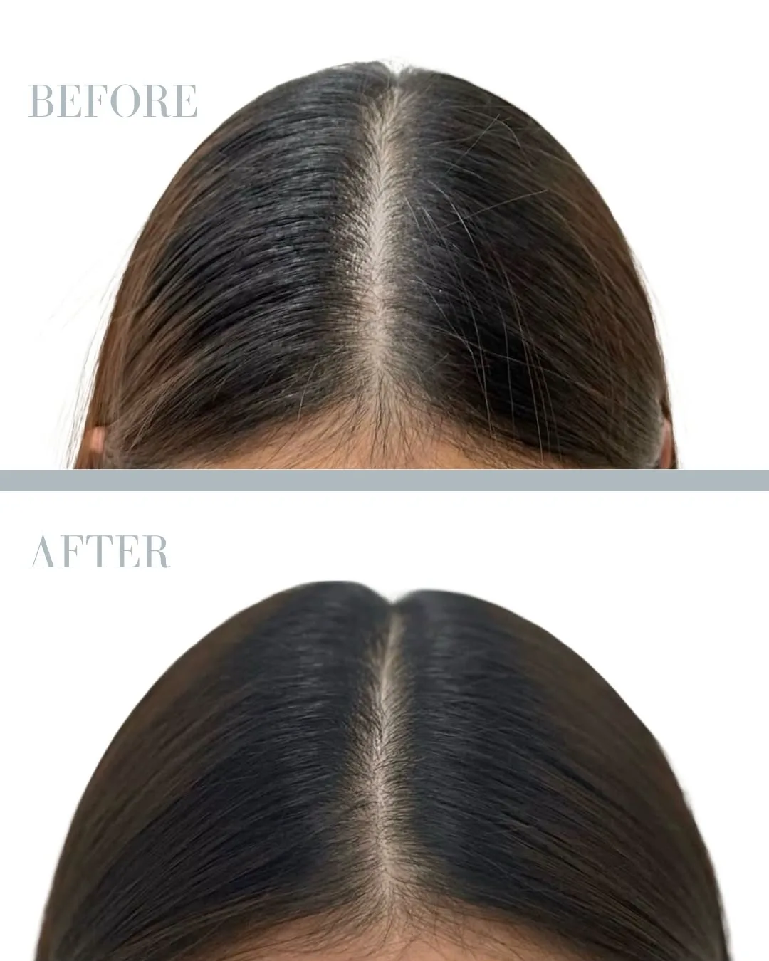 PRP Treatment for Hair Loss in Stockholm resultat