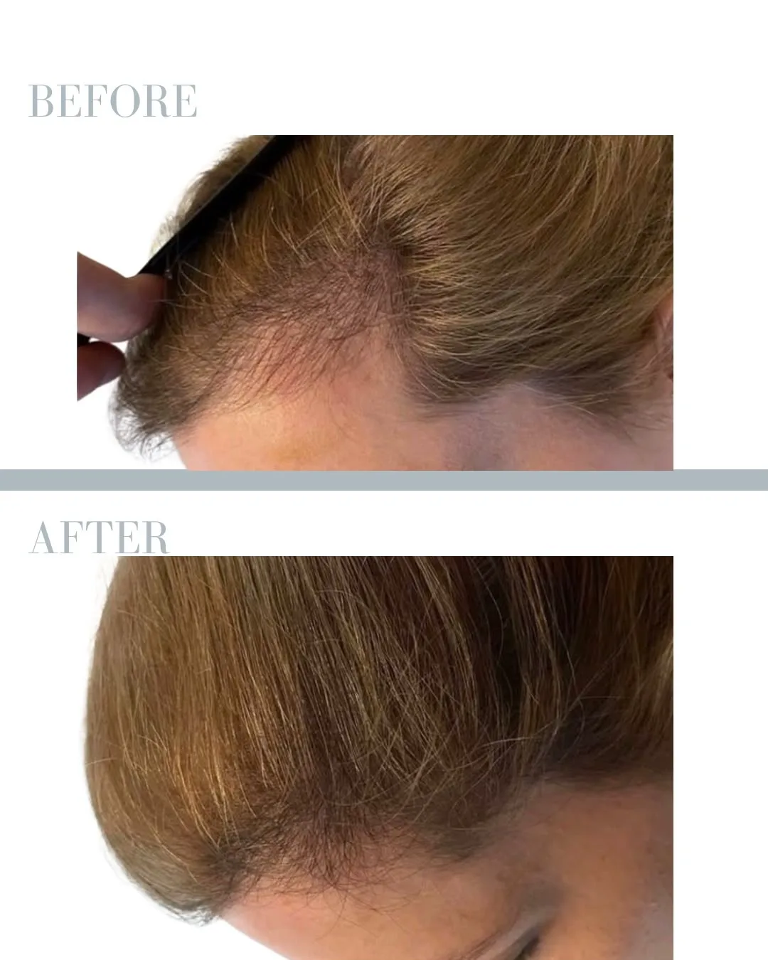 PRP Treatment for Hair Loss in Stockholm resultat