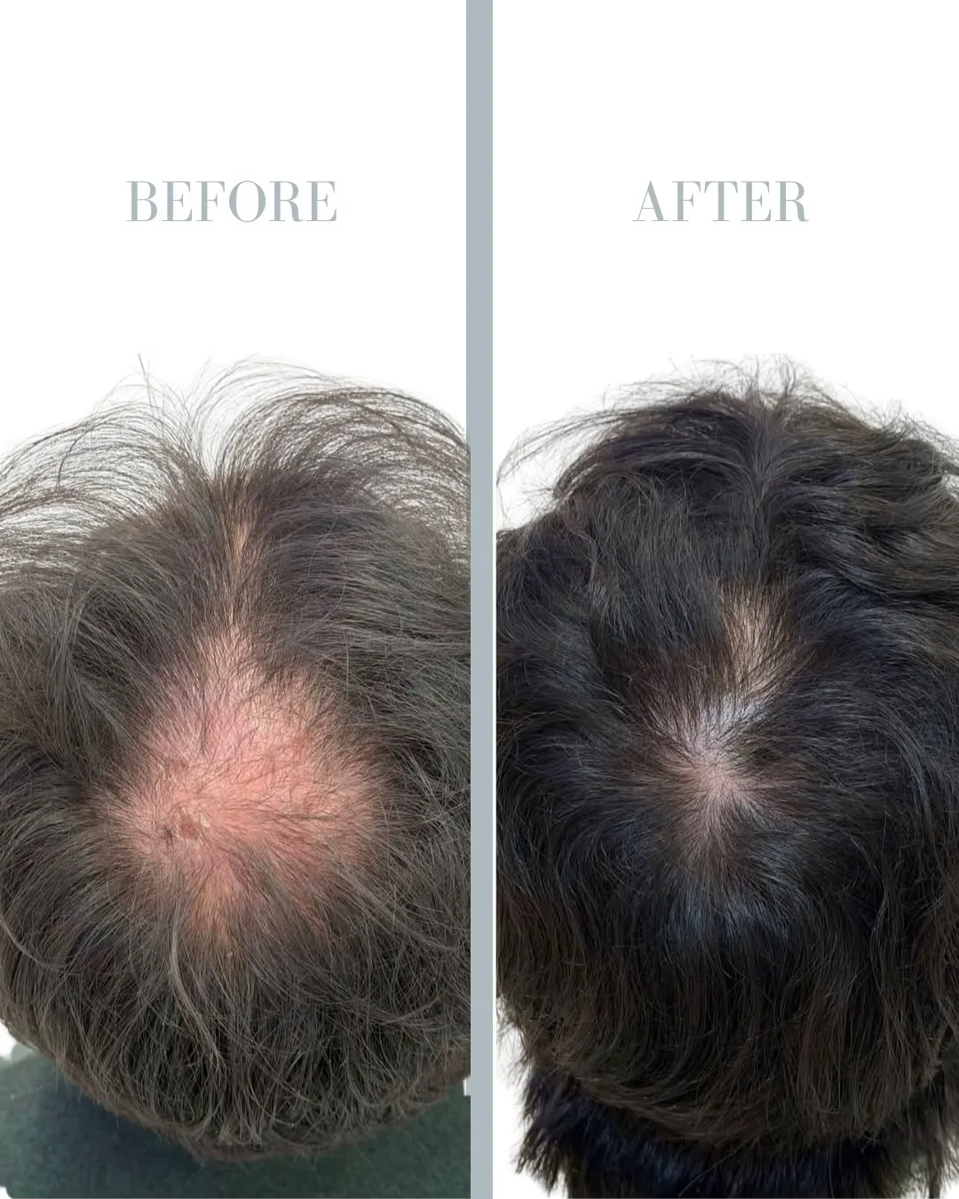 PRP Treatment for Hair Loss in Stockholm resultat 3