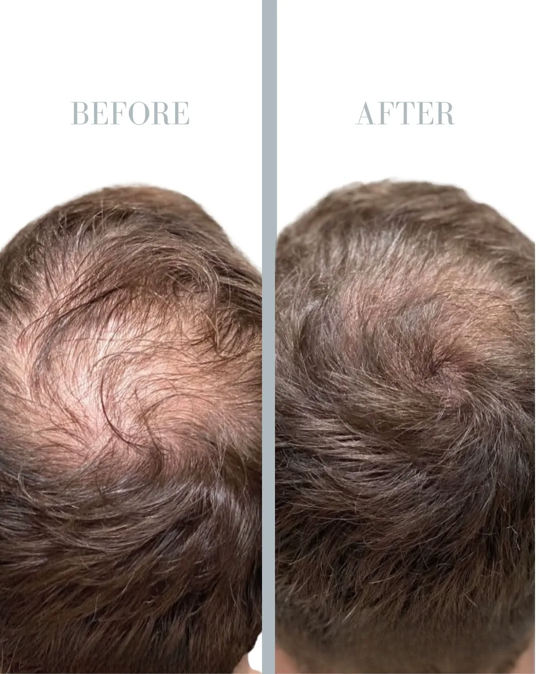 PRP Treatment for Hair Loss in Stockholm resultat 4