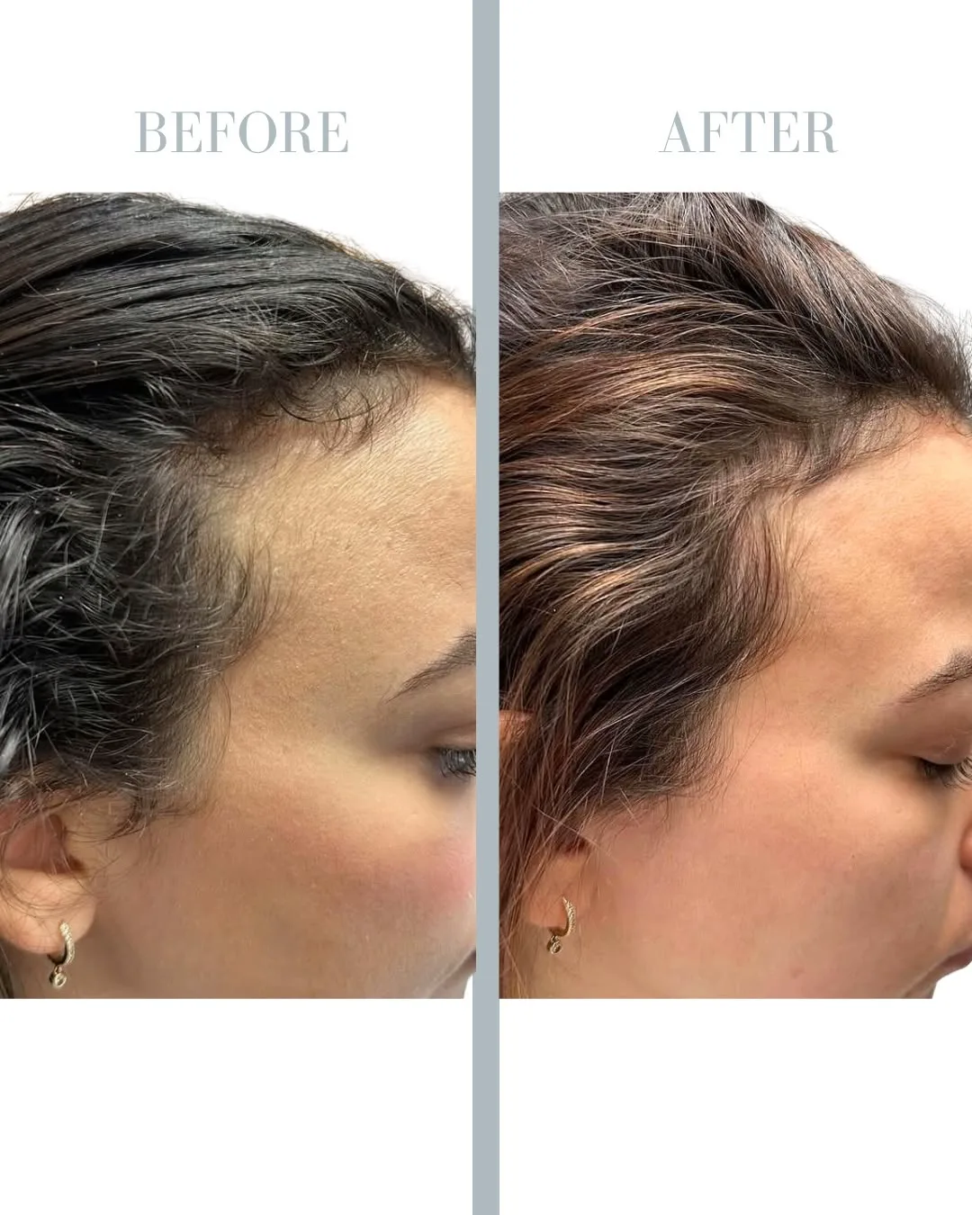PRP Treatment for Hair Loss in Stockholm resultat 5