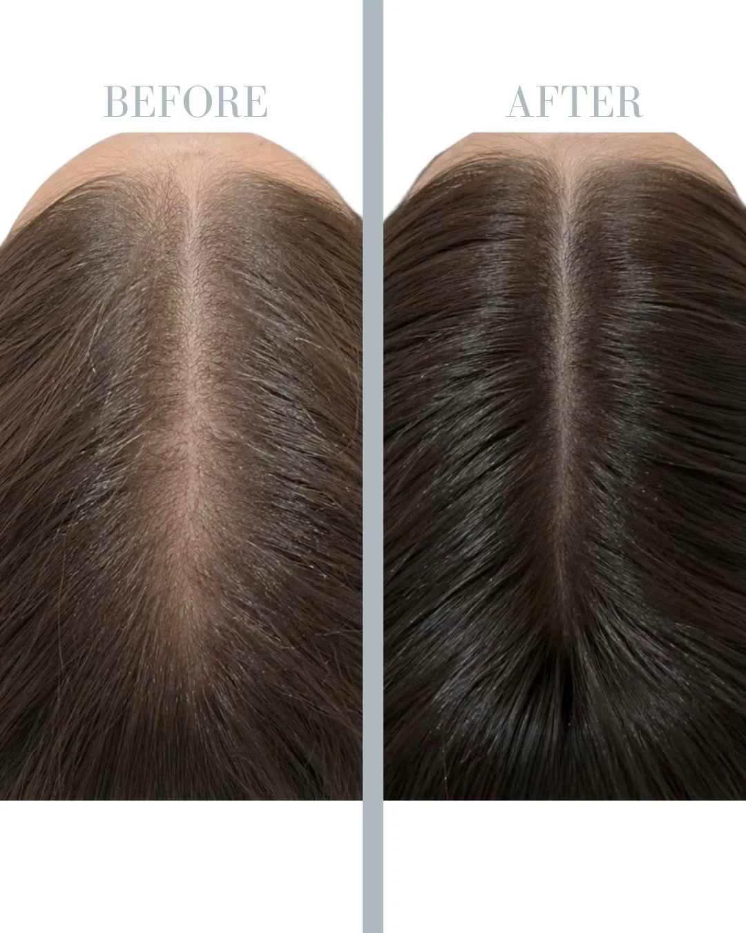 PRP Treatment for Hair Loss in Stockholm resultat 6