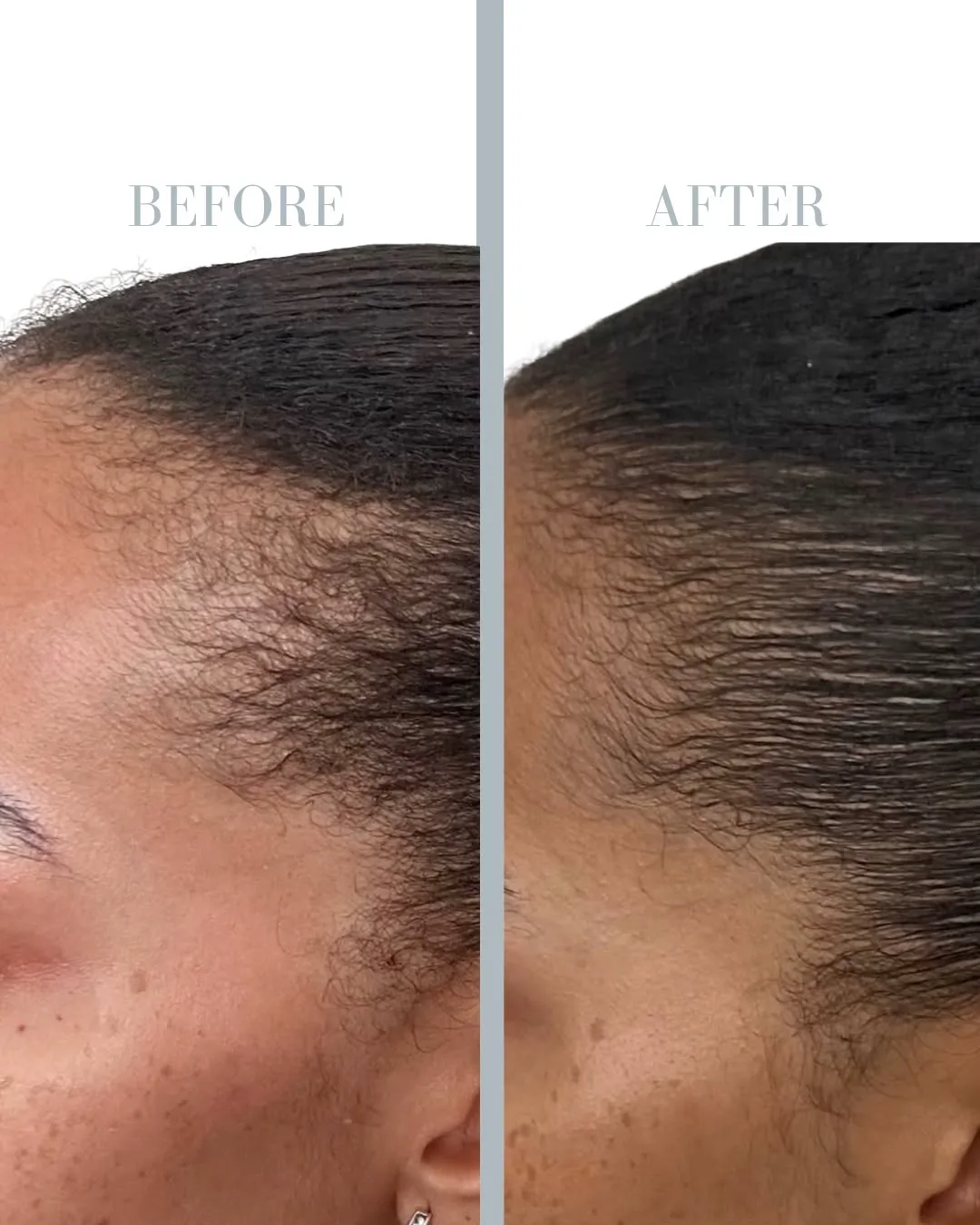 PRP Treatment for Hair Loss in Stockholm resultat 7