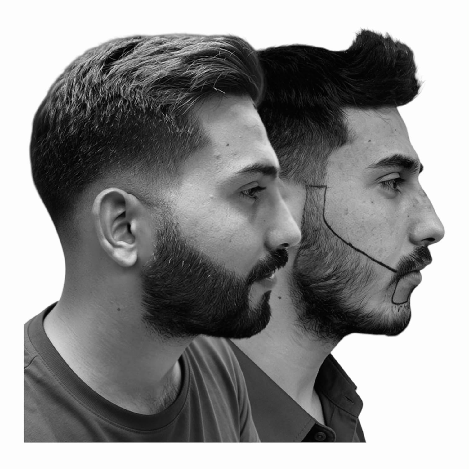 Resultat efter skäggtransplantation bredvid designad och markerad skägglinje inför behandlingen